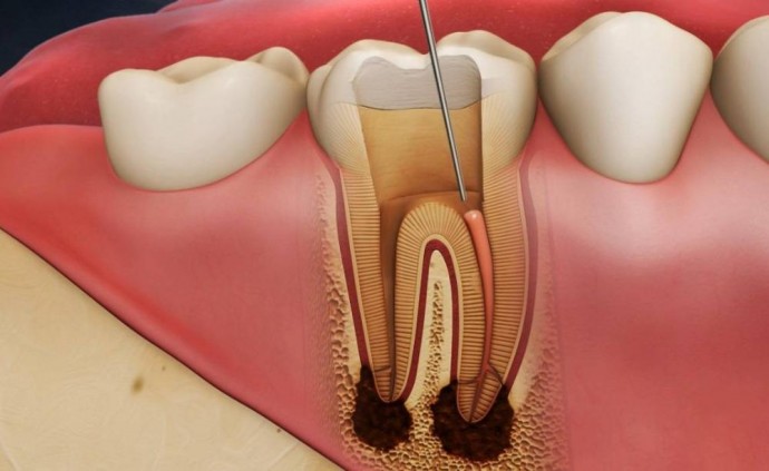 Почему важно своевременно обращаться к стоматологу при пульпите